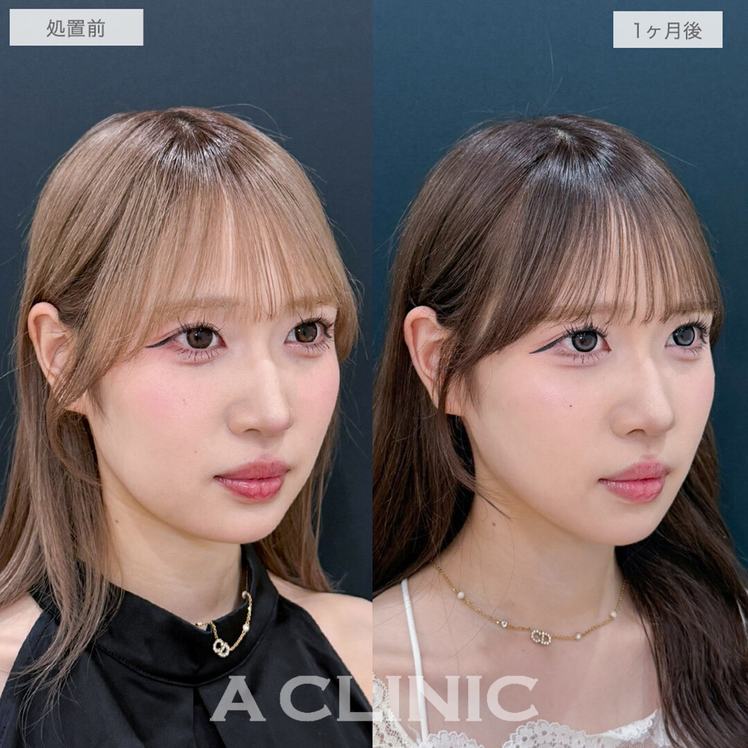 1day小顔脂肪吸引でぼやけていたフェイスラインがくっきりVフェイスに！処置前と1ヶ月後の症例です(20代女性)