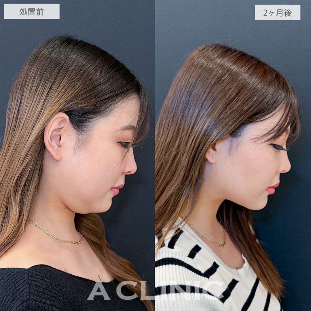 1day小顔脂肪吸引とあごへのヒアルロン酸注入と小顔エラボトックスで頑固な二重あごもなくなりお顔がひと回り小さくなりました！処置前と2ヶ月後の症例です(20代女性)