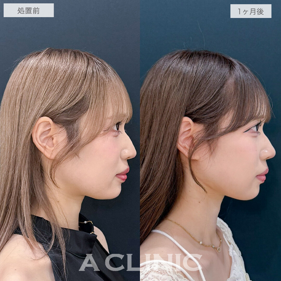 1day小顔脂肪吸引でぼやけていたフェイスラインがくっきりVフェイスに！処置前と1ヶ月後の症例です(20代女性)