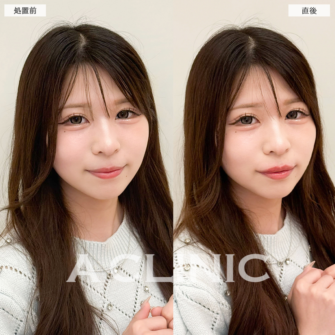 スマイルリップでもっと写真映えするお顔に！こちら処置前と直後の症例です(10代女性)