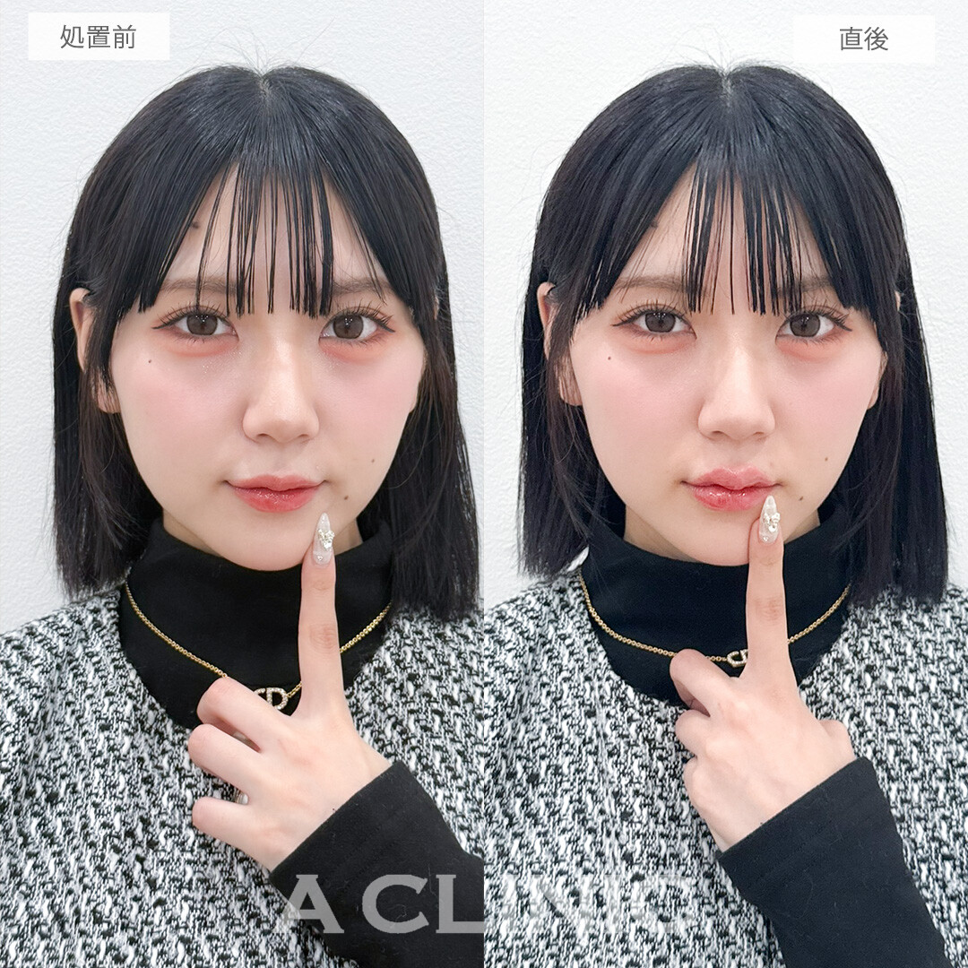 スマイルリップでぽてっとしたぷっくり唇になれました！処置前と直後の症例です(20代女性)