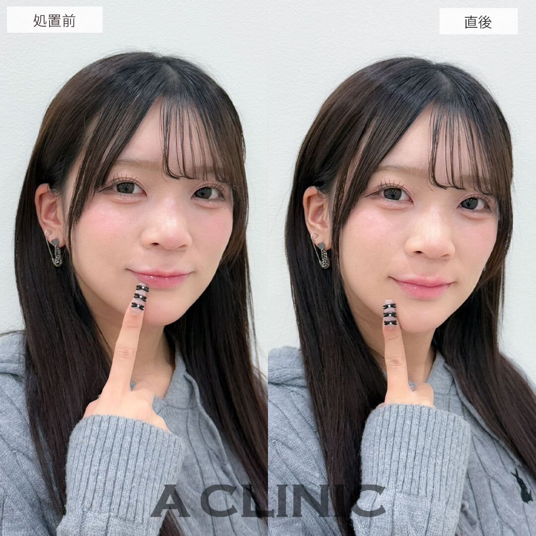 スマイルリップでボリュームを出し横から見ても可愛いぷるぷるM字リップに！こちら処置前と直後の症例です(20代女性)