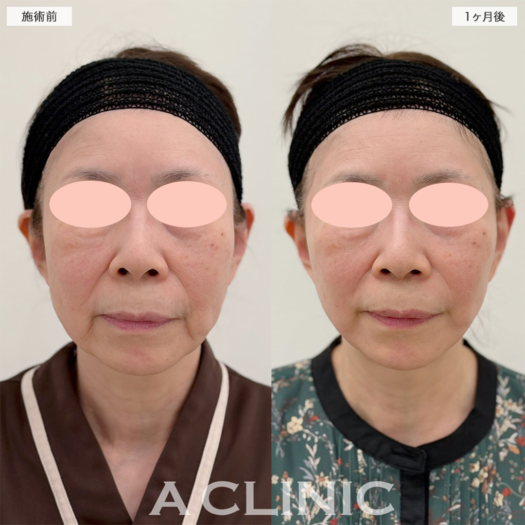 A式美肌たるみ切開で念願の若返りが叶いました！こちら処置前と1ヶ月後の症例です(60代女性)