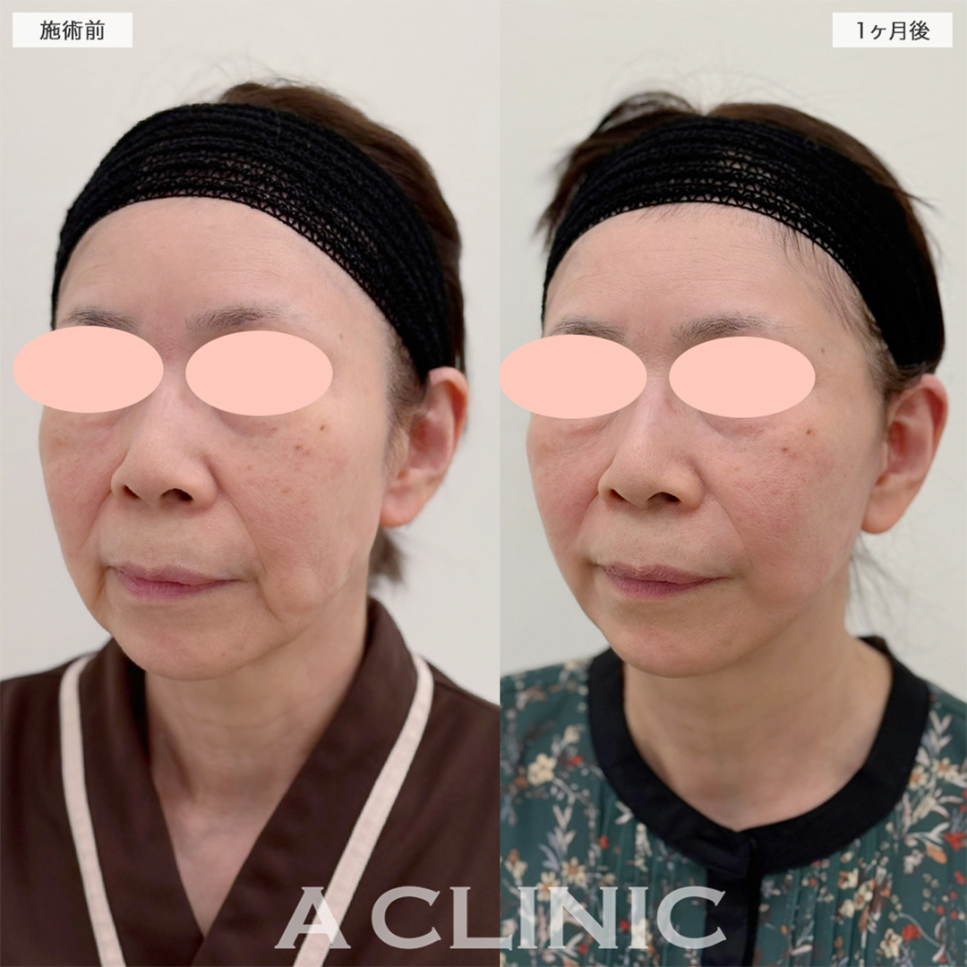 A式美肌たるみ切開で念願の若返りが叶いました！こちら処置前と1ヶ月後の症例です(60代女性)