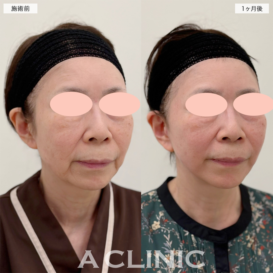 A式美肌たるみ切開で念願の若返りが叶いました！こちら処置前と1ヶ月後の症例です(60代女性)
