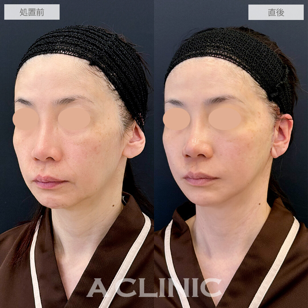 A式美肌たるみ切開で、ほうれい線も輪郭もスッキリ！処置前と直後の症例です(50代女性)