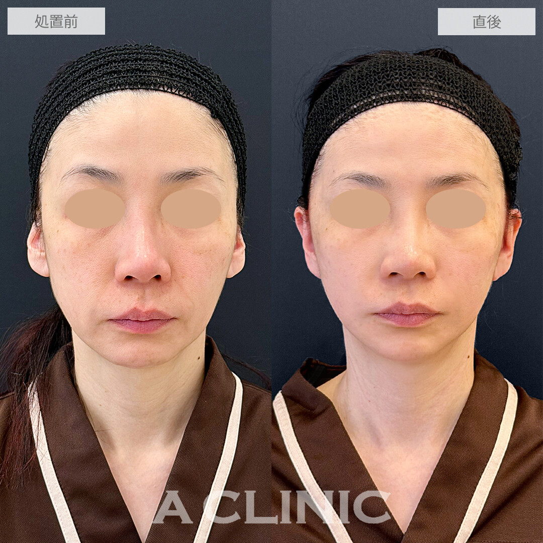 A式美肌たるみ切開で、ほうれい線も輪郭もスッキリ！処置前と直後の症例です(50代女性)