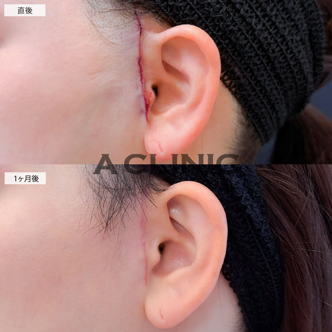 【直後の傷跡あり】A式美肌たるみ切開と1day小顔脂肪吸引で口横のもたつきを解消し自然とリフトアップ！こちら処置前後と1ヶ月後の症例です(20代女性)