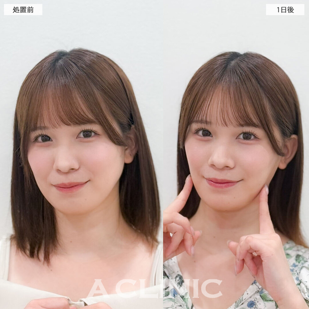 1day小顔脂肪吸引は翌日でもこんなに小顔になれます！こちら処置前と1日後の症例です(20代女性)