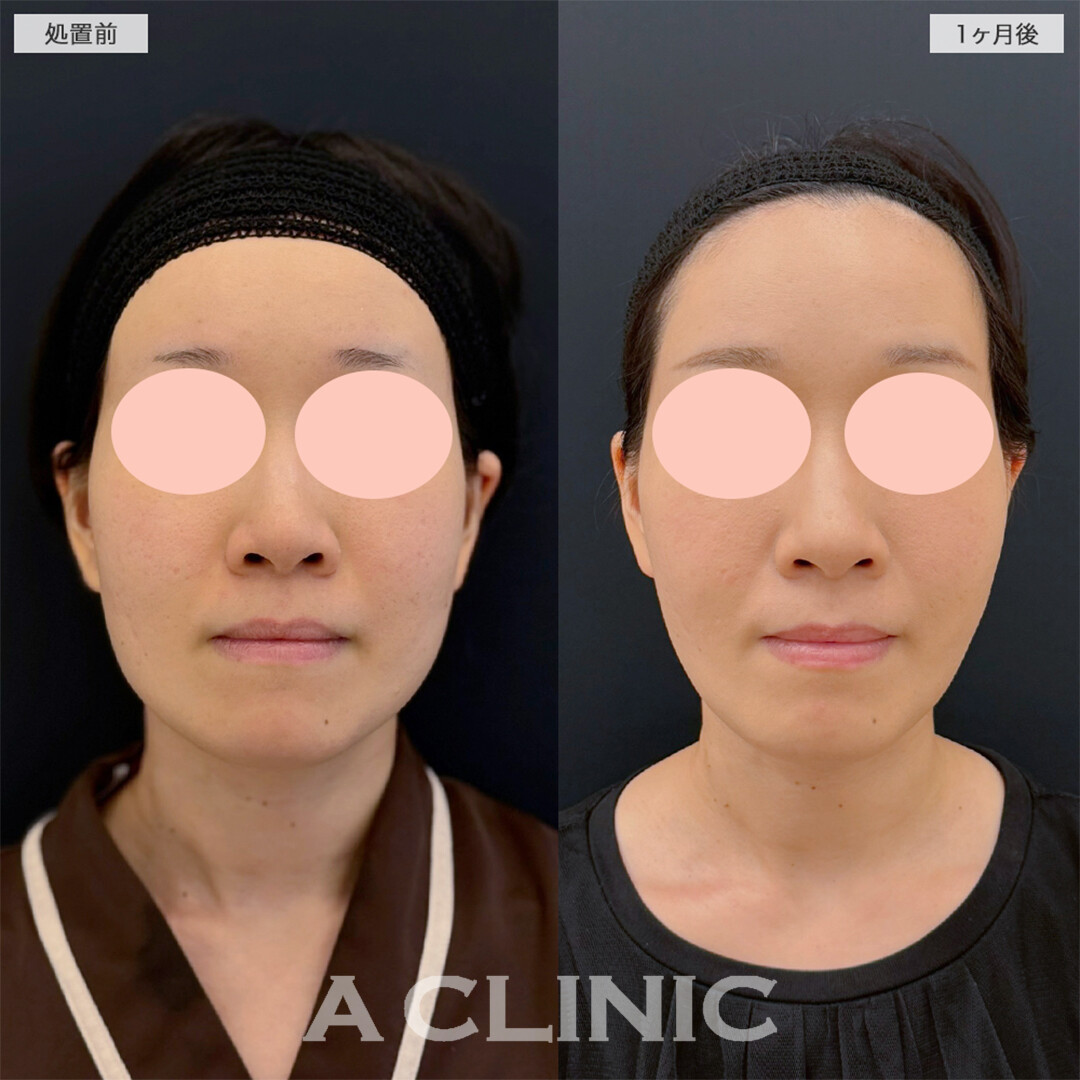 1day小顔脂肪吸引で余白が無くなりバランスの良い形になりました！こちら処置前と1ヶ月後の症例です(30代女性)
