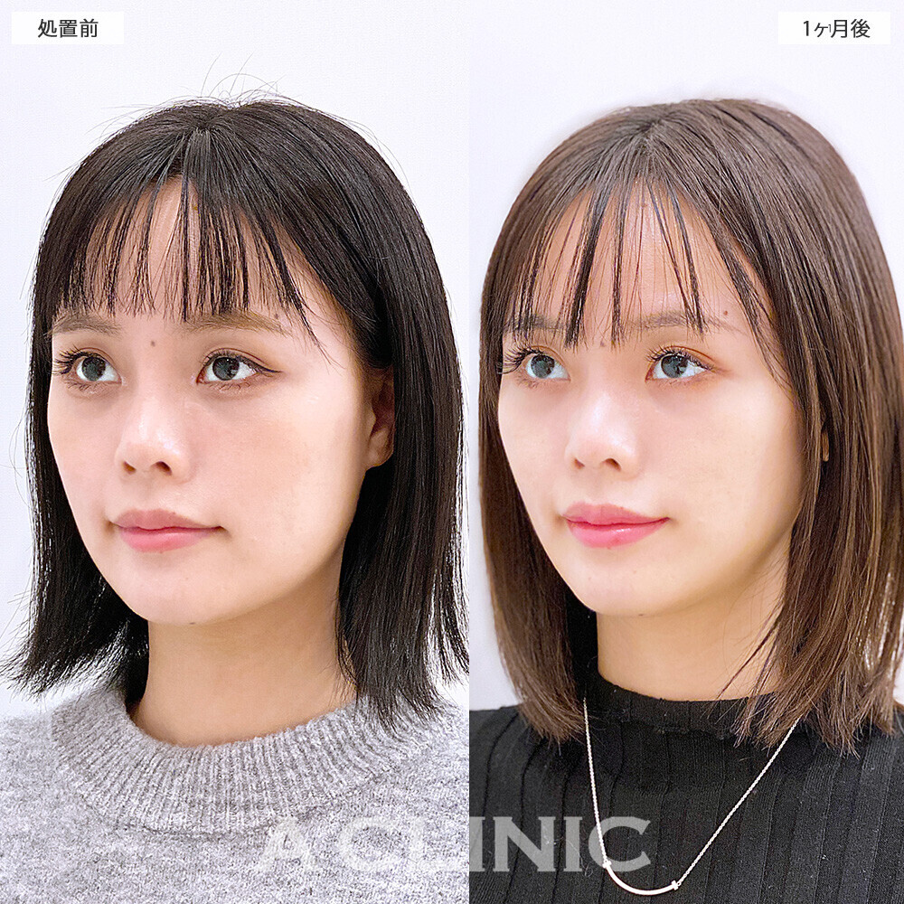 1day小顔脂肪吸引で顔の余白解消！こちら処置前から2ヶ月後の症例です。(20代女性)