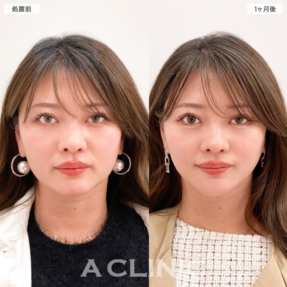 1day小顔脂肪吸引で無駄な余白がなくなりバランスの取れたお顔に！こちら処置前から２ヶ月後の症例です。(30代女性)