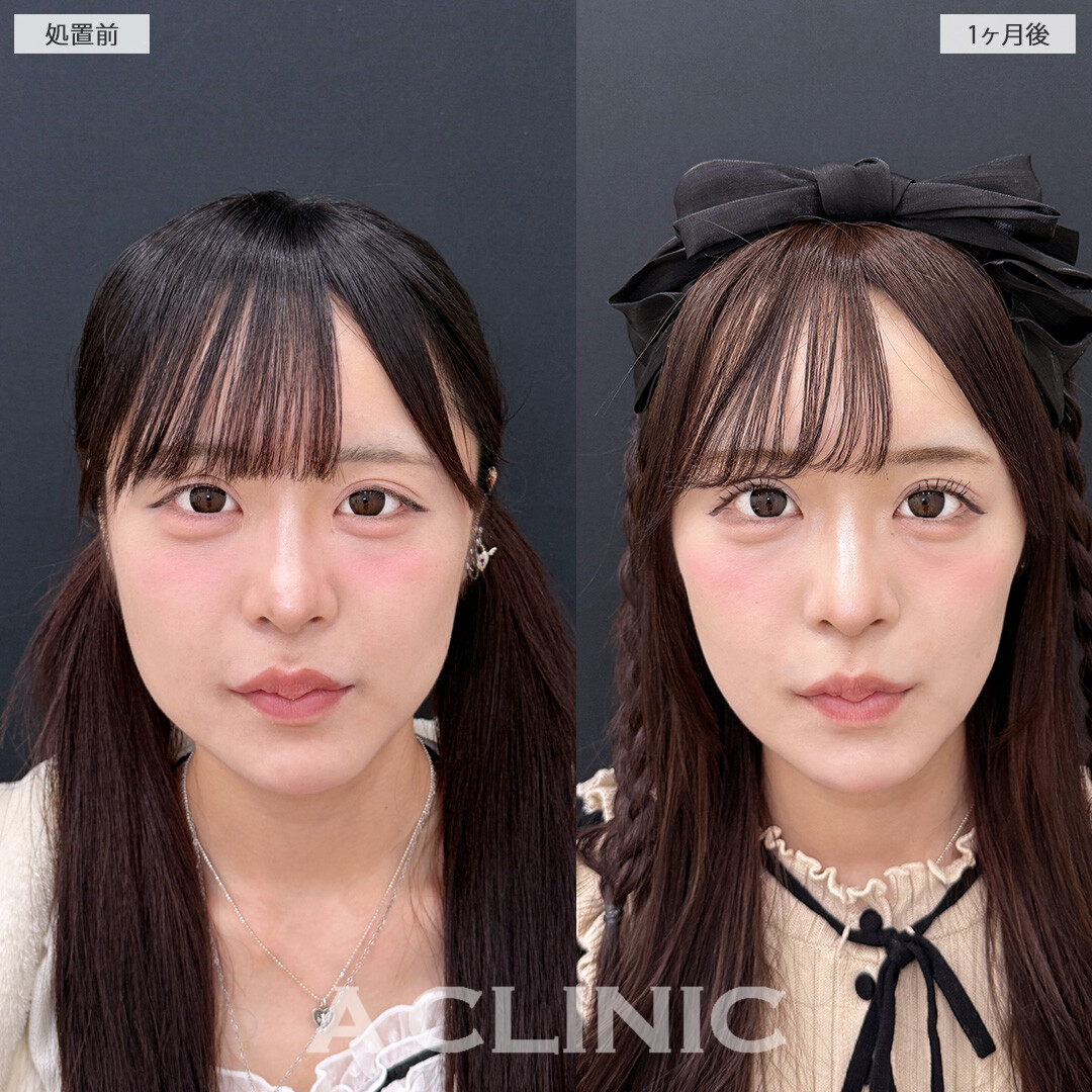 ダウンタイム最小限でスッキリとした小顔になりました！こちら1day小顔脂肪吸引と小顔エラボトックスの処置前と1ヶ月後の症例です(20代女性)