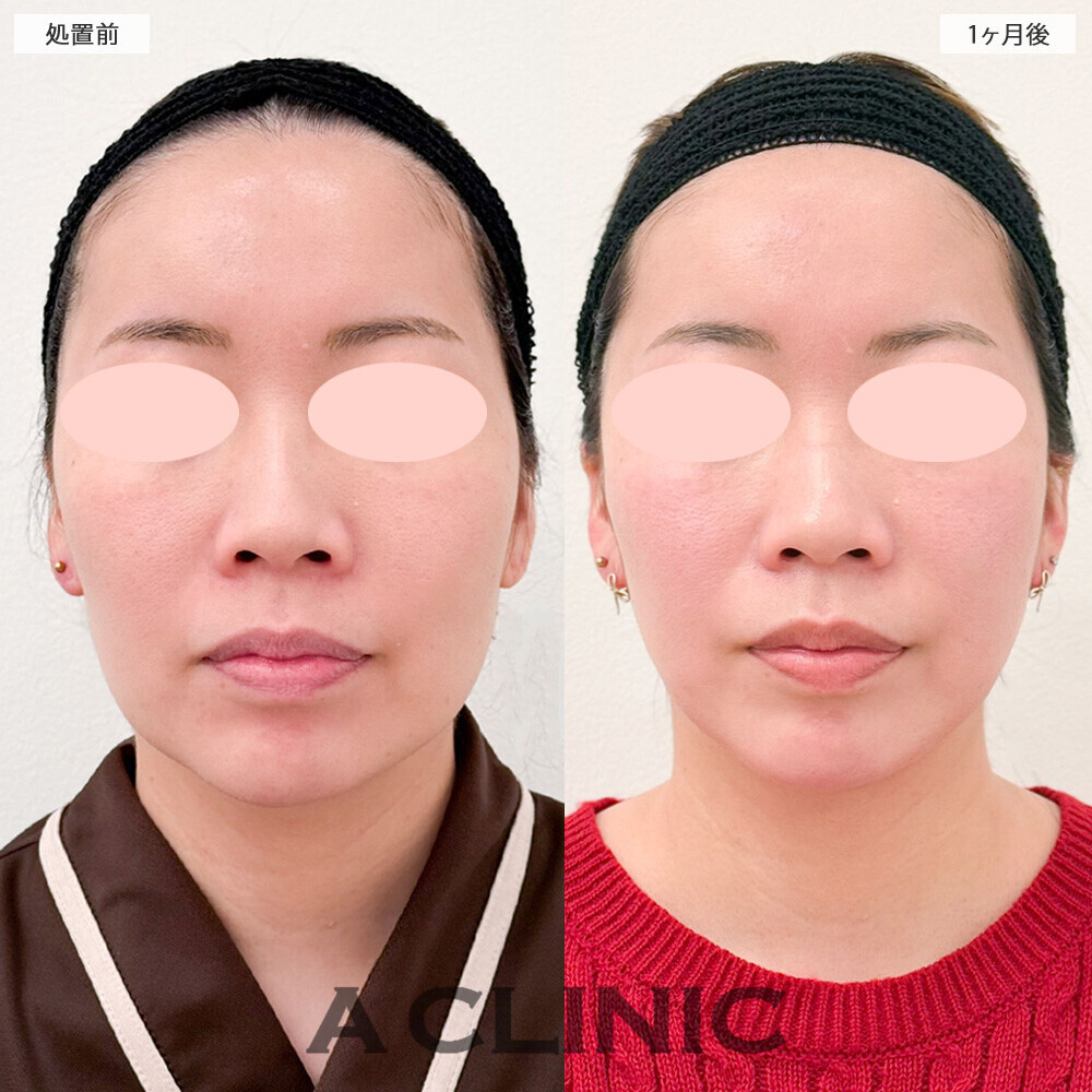 1day小顔脂肪吸引で脂肪もたるみもスッキリしました！処置前から2ヶ月後の症例です(30代女性)