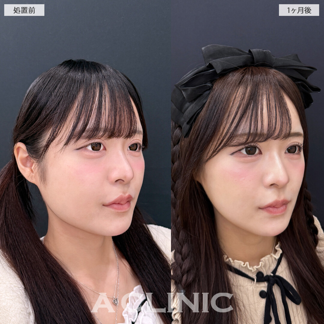 ダウンタイム最小限でスッキリとした小顔になりました！こちら1day小顔脂肪吸引と小顔エラボトックスの処置前と1ヶ月後の症例です(20代女性)