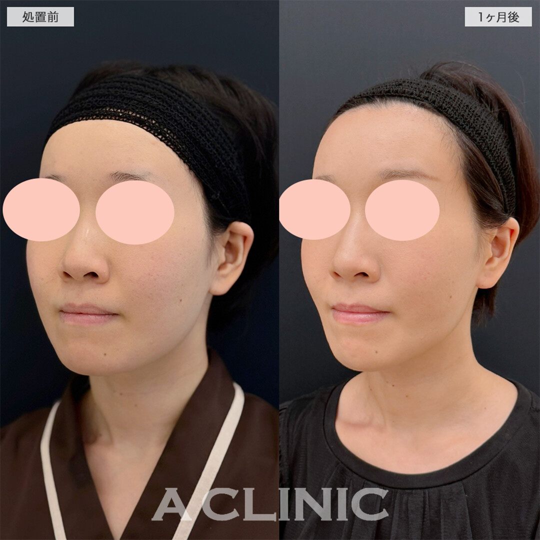 1day小顔脂肪吸引で余白が無くなりバランスの良い形になりました！こちら処置前と1ヶ月後の症例です(30代女性)