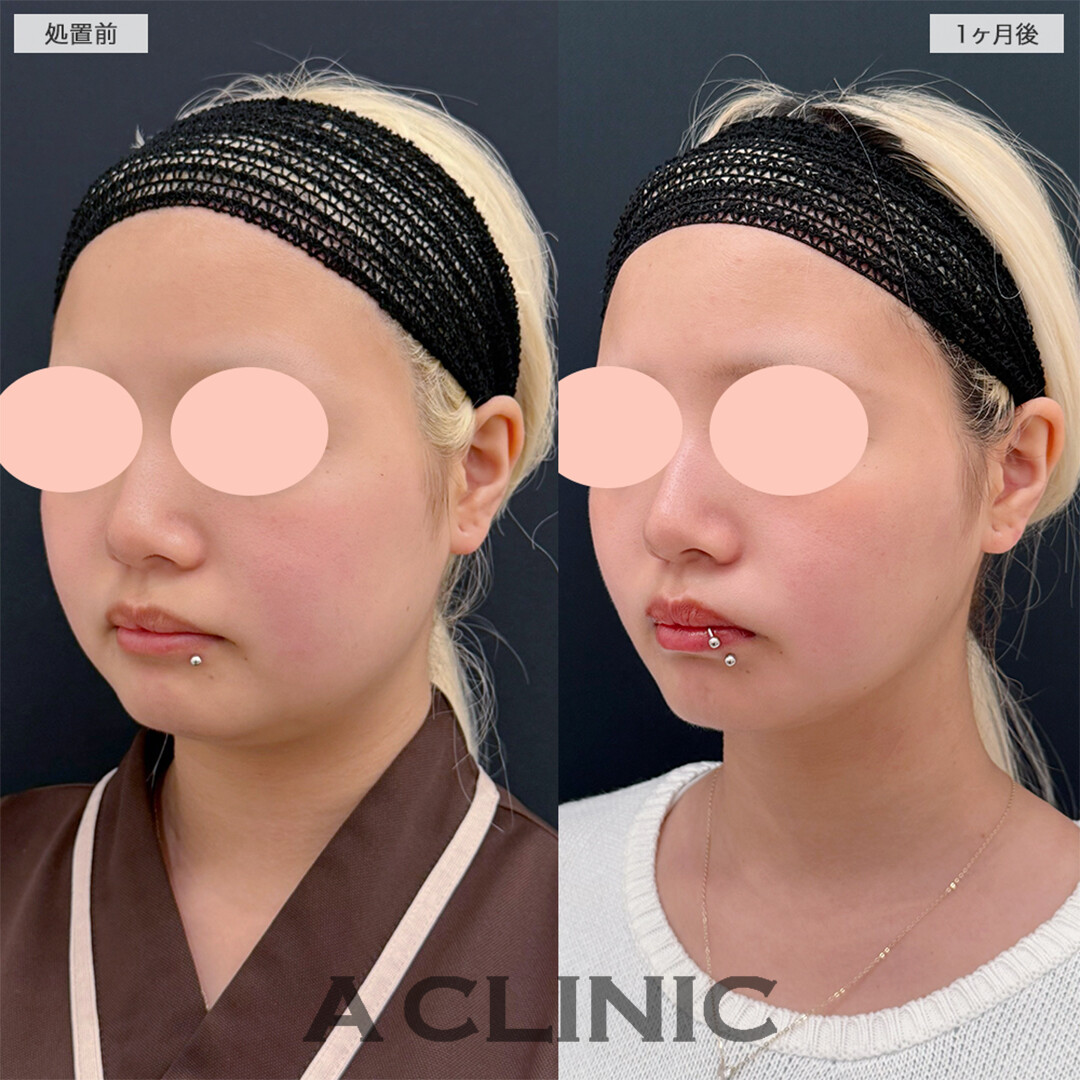1day小顔脂肪吸引で念願の丸顔脱出！こちら処置前と1ヶ月後の症例です(20代女性)