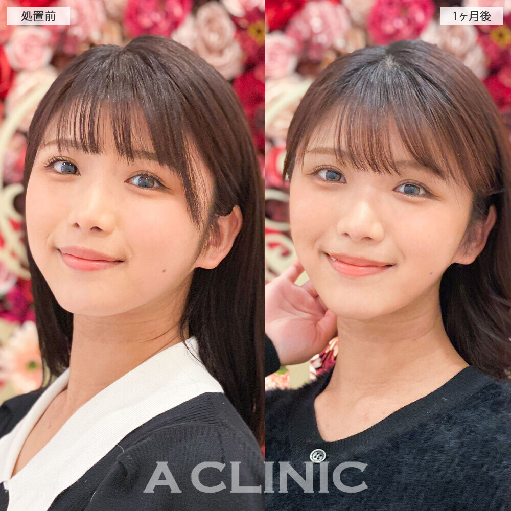 1day小顔脂肪吸引で丸顔から卵形の輪郭に！こちら処置前から２ヶ月後の症例です。(20代女性)