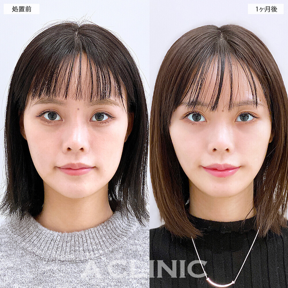 1day小顔脂肪吸引で顔の余白解消！こちら処置前から2ヶ月後の症例です。(20代女性)