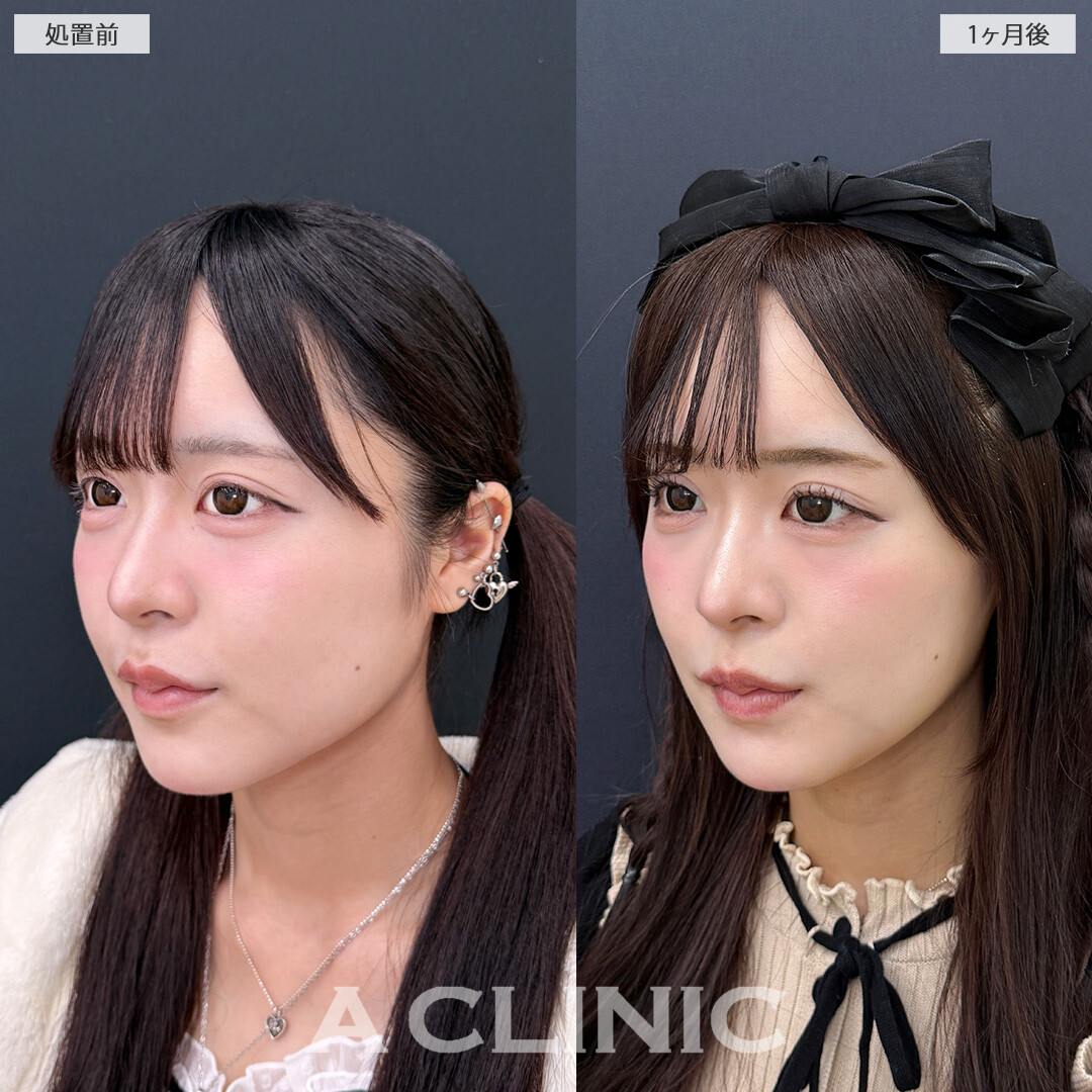 ダウンタイム最小限でスッキリとした小顔になりました！こちら1day小顔脂肪吸引と小顔エラボトックスの処置前と1ヶ月後の症例です(20代女性)