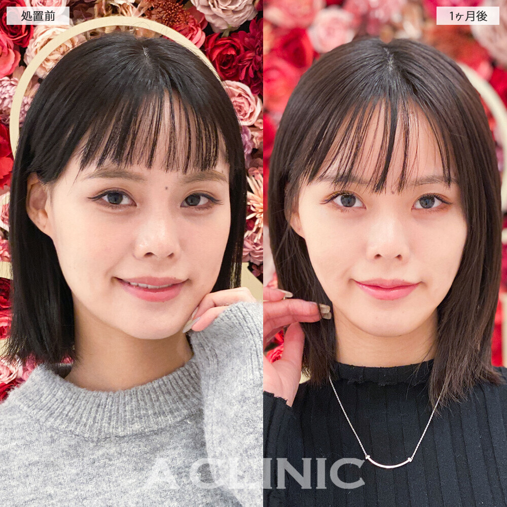 1day小顔脂肪吸引で顔の余白解消！こちら処置前から2ヶ月後の症例です。(20代女性)