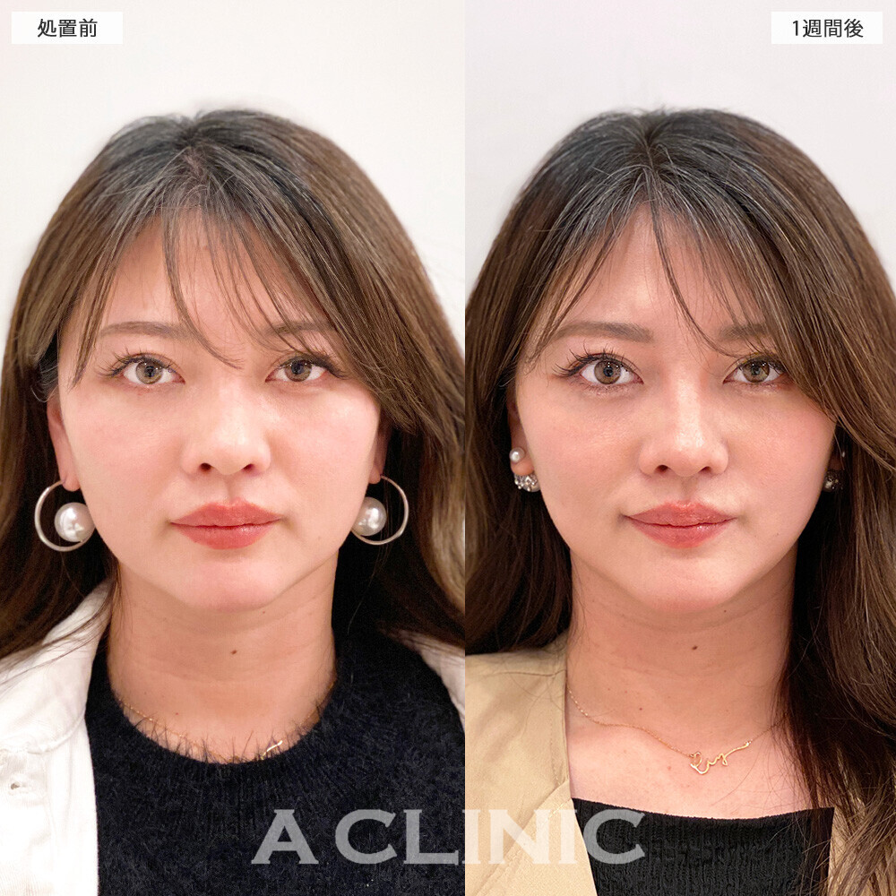 1day小顔脂肪吸引で無駄な余白がなくなりバランスの取れたお顔に！こちら処置前から２ヶ月後の症例です。(30代女性)