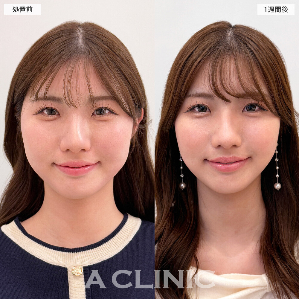 1day小顔脂肪吸引で映える卵型フェイスに！処置前から2ヶ月後の症例です(20代女性)