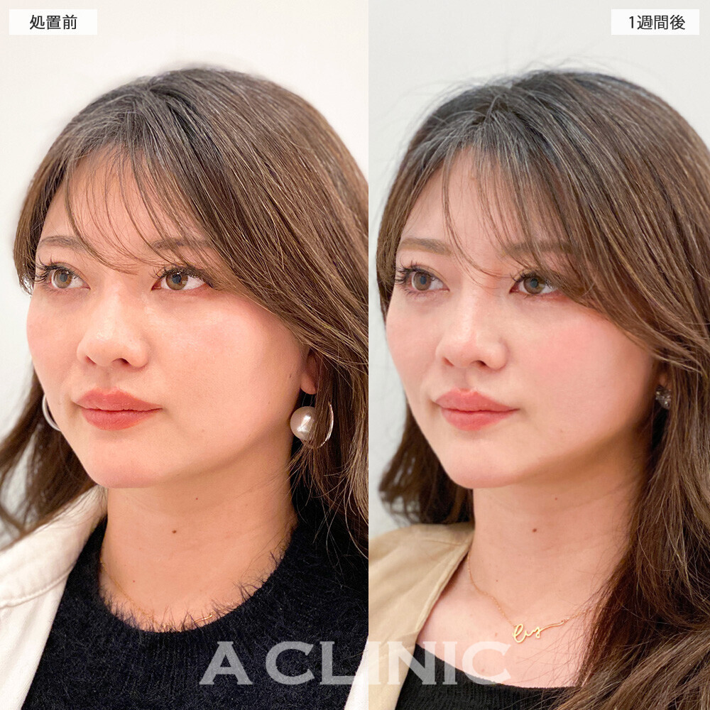 1day小顔脂肪吸引で無駄な余白がなくなりバランスの取れたお顔に！こちら処置前から２ヶ月後の症例です。(30代女性)