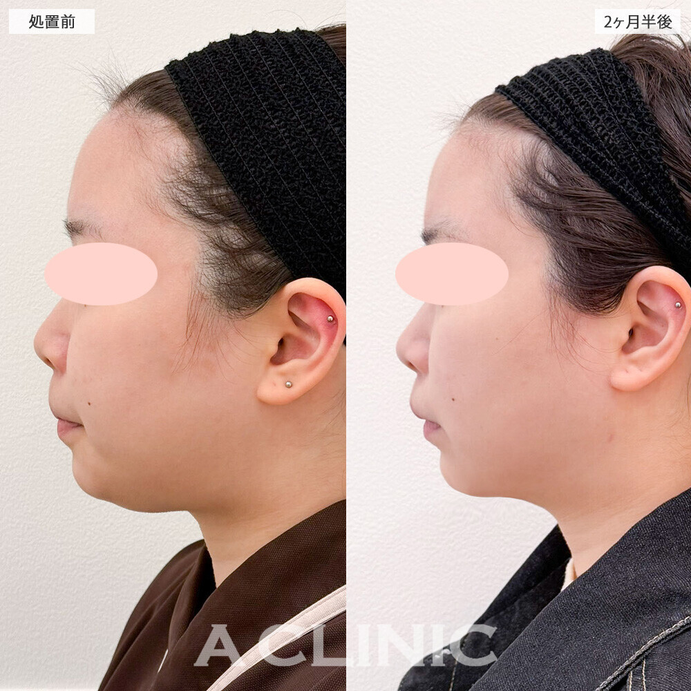 1day小顔脂肪吸引で理想のVフェイスに！処置前から2ヶ月半後の症例です(20代女性)