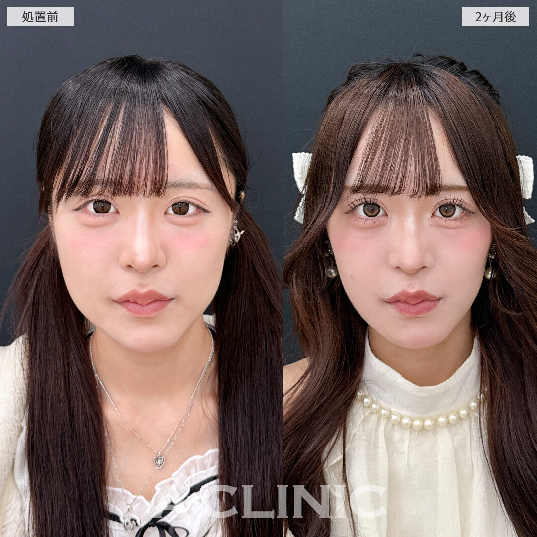 1day小顔脂肪吸引と小顔エラボトックスでひと回り小顔になって中顔面も整いました！こちら処置前と2ヶ月後の症例です(20代女性)