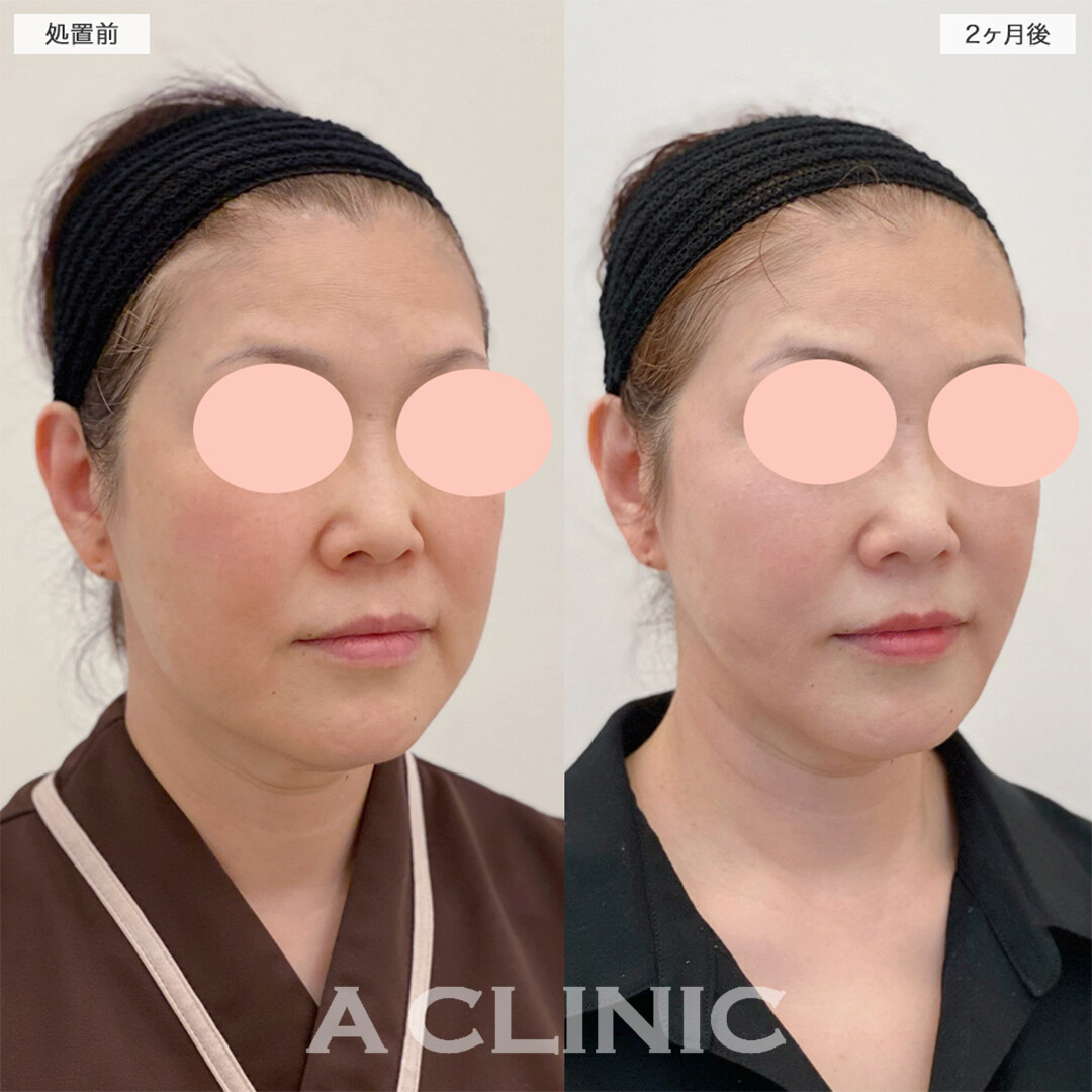1day小顔脂肪吸引でこれからの生活がより楽しみになりました！こちら処置前と2ヶ月後の症例です(60代女性)