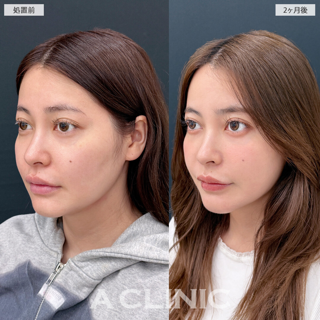 下顔面のもたつきがなくなり美人度アップ！1day小顔脂肪吸引の処置前と2ヶ月後の症例です(30代女性)