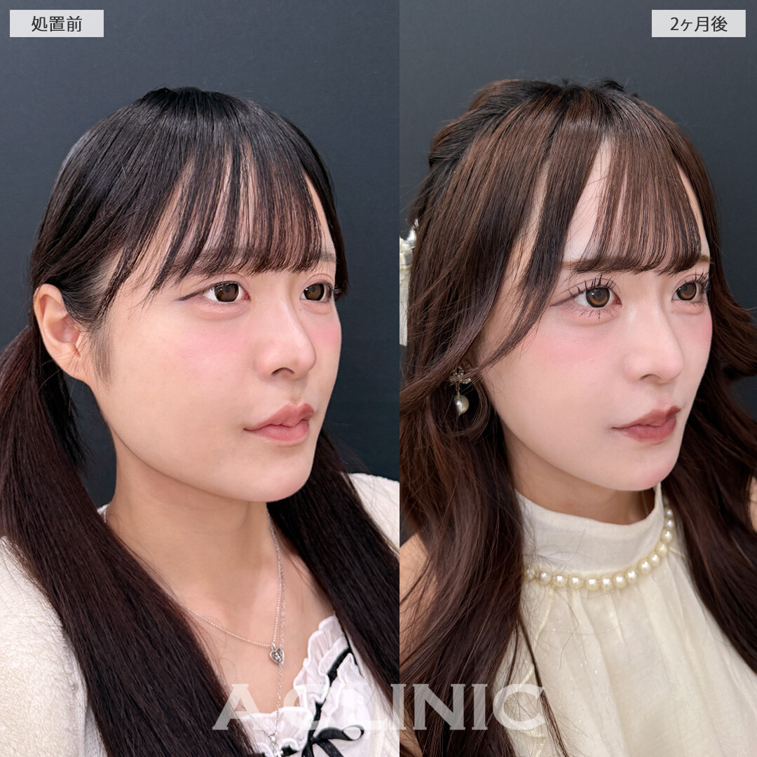 1day小顔脂肪吸引と小顔エラボトックスでひと回り小顔になって中顔面も整いました！こちら処置前と2ヶ月後の症例です(20代女性)