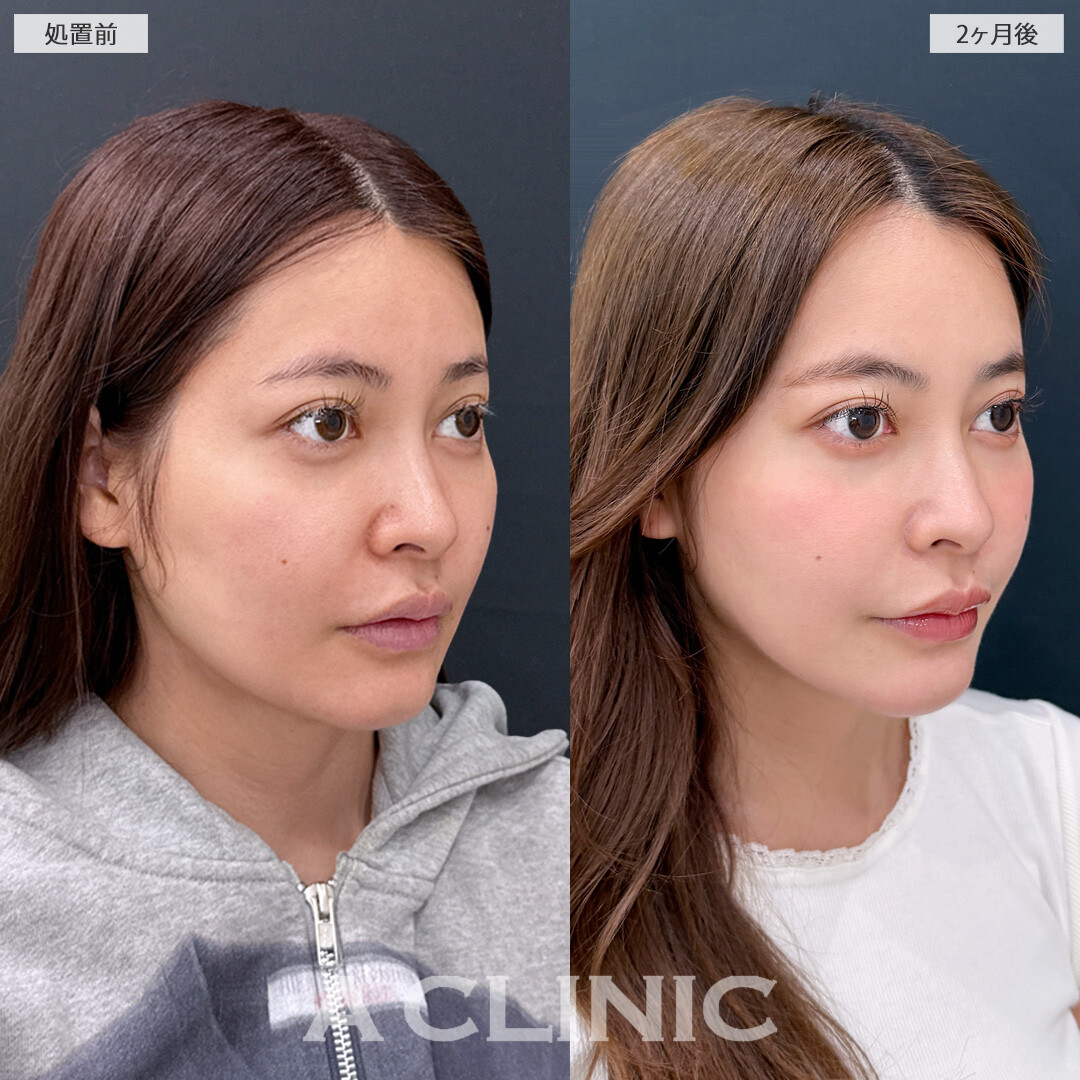 下顔面のもたつきがなくなり美人度アップ！1day小顔脂肪吸引の処置前と2ヶ月後の症例です(30代女性)
