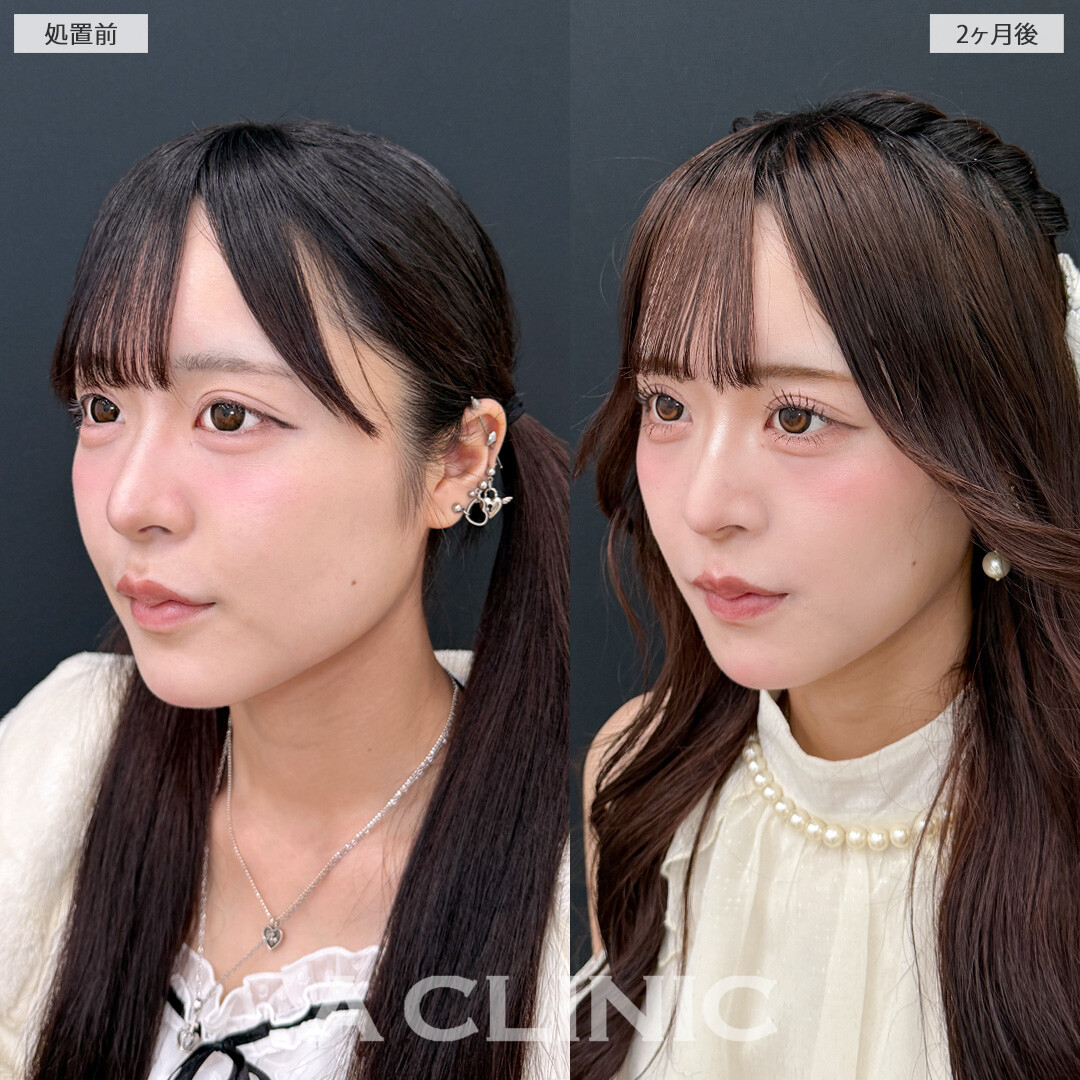 1day小顔脂肪吸引と小顔エラボトックスでひと回り小顔になって中顔面も整いました！こちら処置前と2ヶ月後の症例です(20代女性)