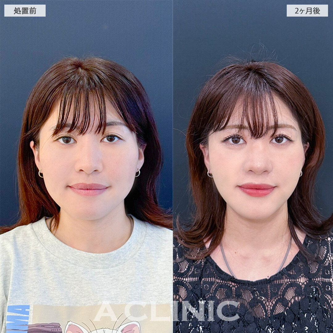 1day小顔脂肪吸引とA式美肌たるみ切開を組み合わせて重心UP！こちら処置前と2ヶ月後の症例です(20代女性)