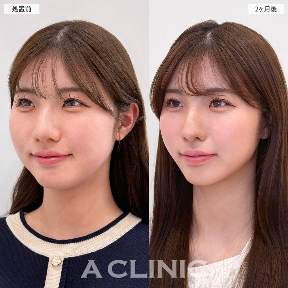1day小顔脂肪吸引で映える卵型フェイスに！処置前から2ヶ月後の症例です(20代女性)