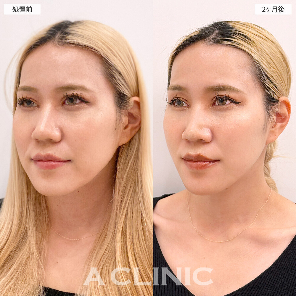 1day小顔脂肪吸引でたるみのないシュッとした輪郭になりました！処置前と2ヶ月後の症例です(20代女性)