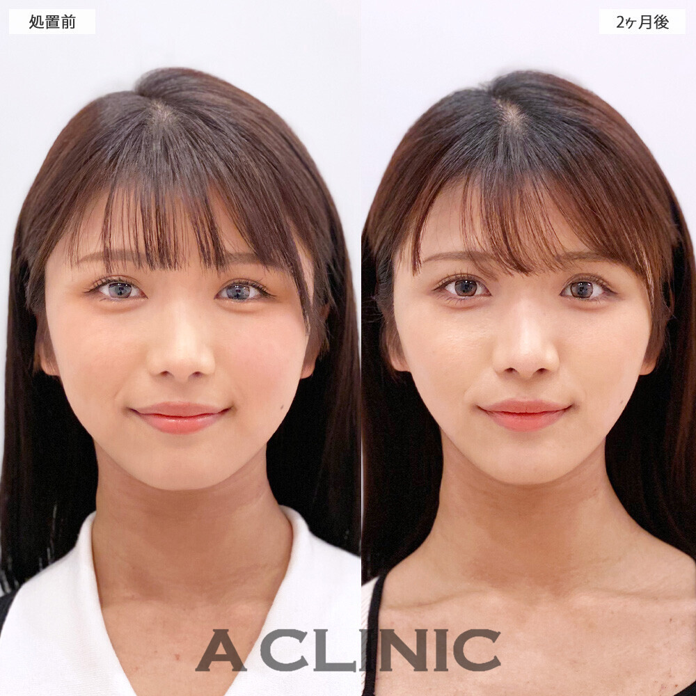 1day小顔脂肪吸引で丸顔から卵形の輪郭に！こちら処置前から２ヶ月後の症例です。(20代女性)