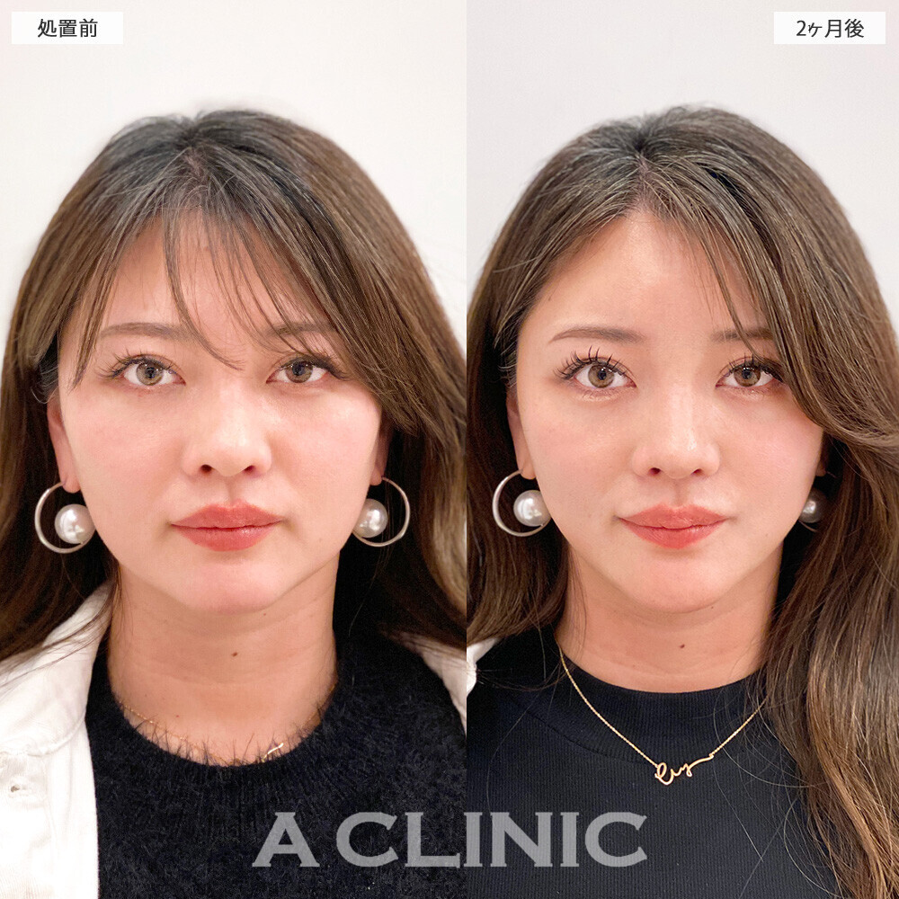 1day小顔脂肪吸引で無駄な余白がなくなりバランスの取れたお顔に！こちら処置前から２ヶ月後の症例です。(30代女性)