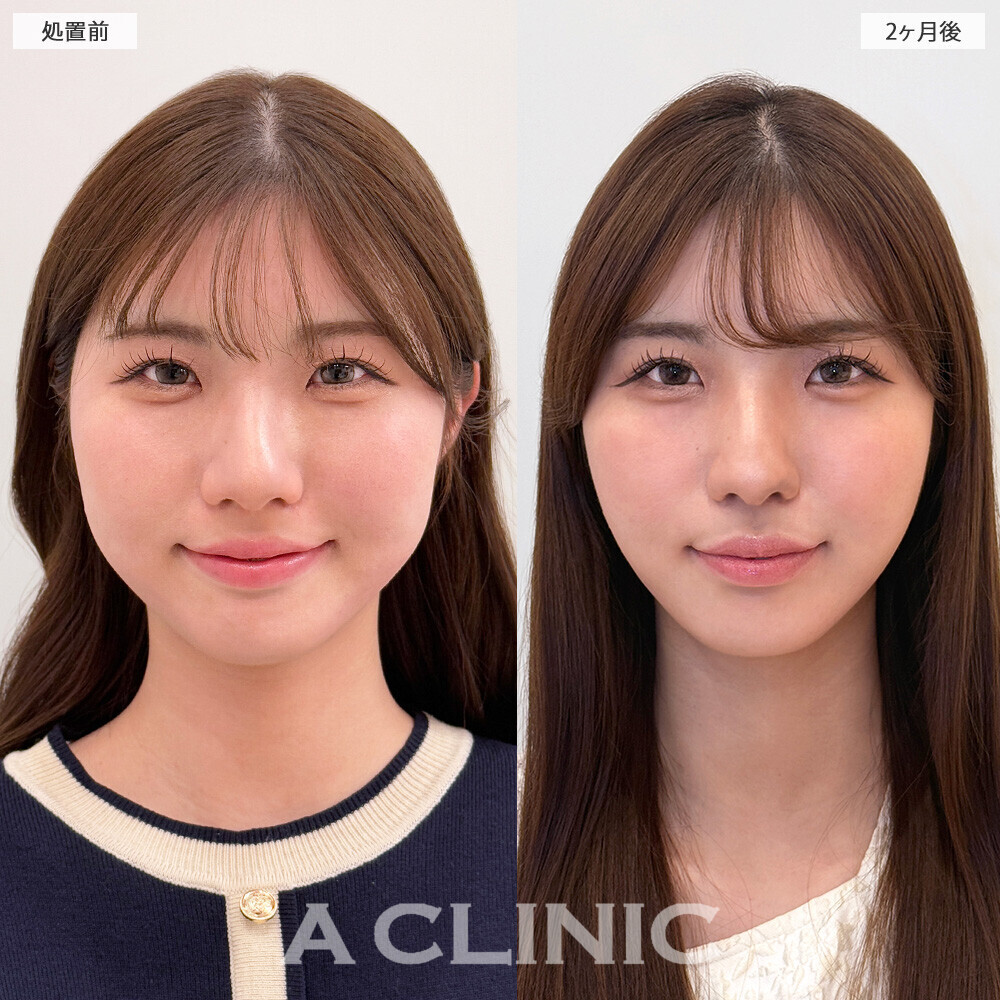 1day小顔脂肪吸引で映える卵型フェイスに！処置前から2ヶ月後の症例です(20代女性)