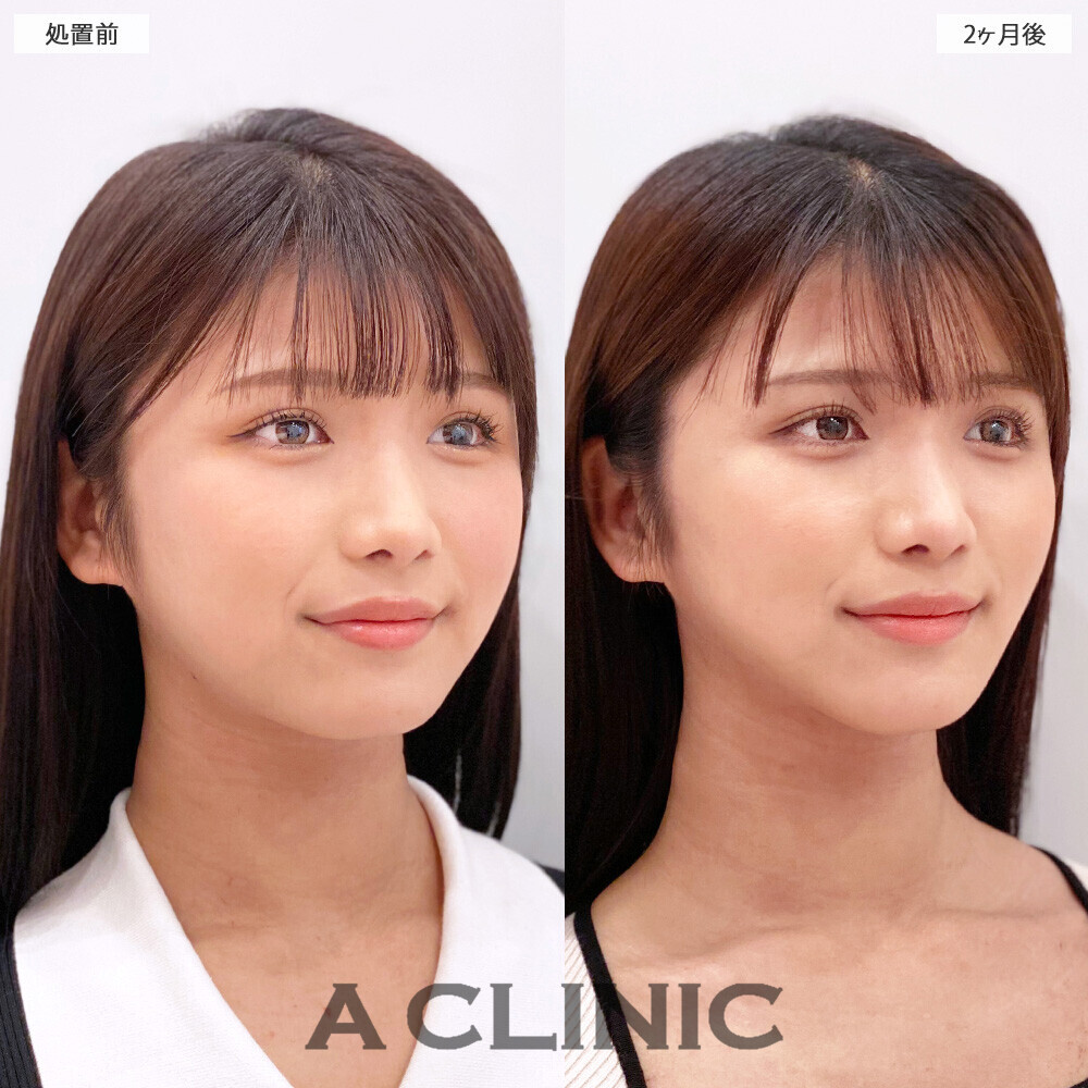 1day小顔脂肪吸引で丸顔から卵形の輪郭に！こちら処置前から２ヶ月後の症例です。(20代女性)