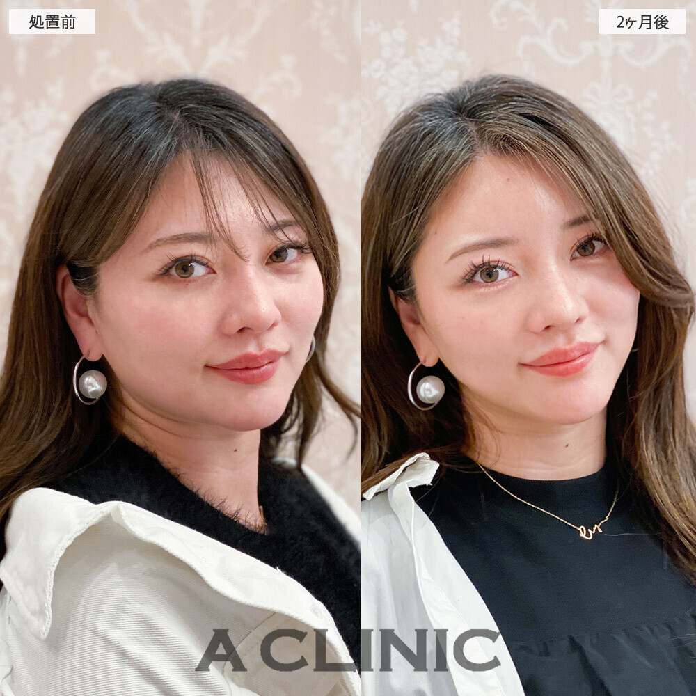 1day小顔脂肪吸引で無駄な余白がなくなりバランスの取れたお顔に！こちら処置前から２ヶ月後の症例です。(30代女性)