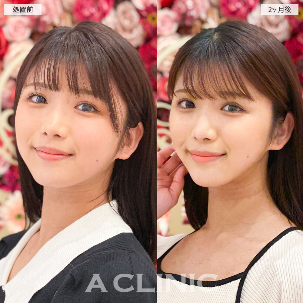 1day小顔脂肪吸引で丸顔から卵形の輪郭に！こちら処置前から２ヶ月後の症例です。(20代女性)