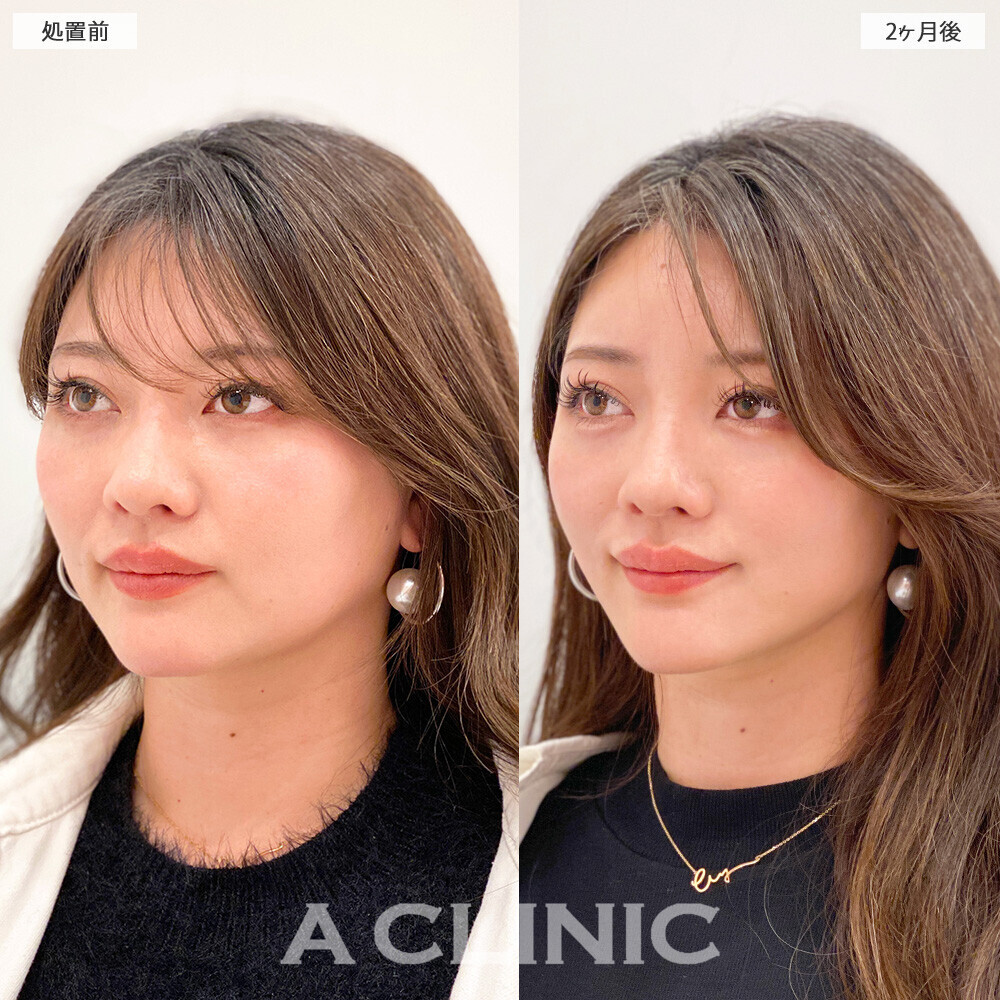 1day小顔脂肪吸引で無駄な余白がなくなりバランスの取れたお顔に！こちら処置前から２ヶ月後の症例です。(30代女性)