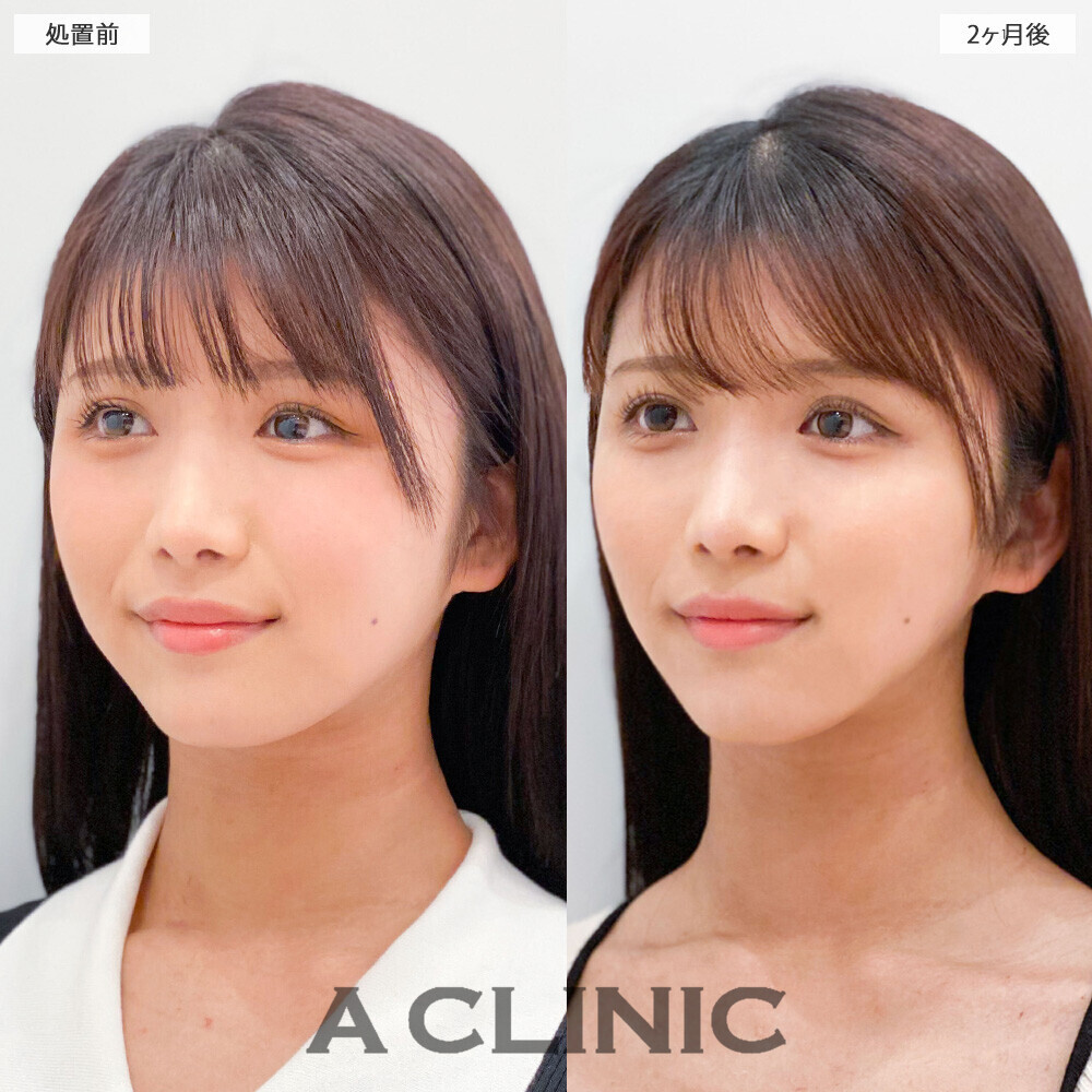 1day小顔脂肪吸引で丸顔から卵形の輪郭に！こちら処置前から２ヶ月後の症例です。(20代女性)