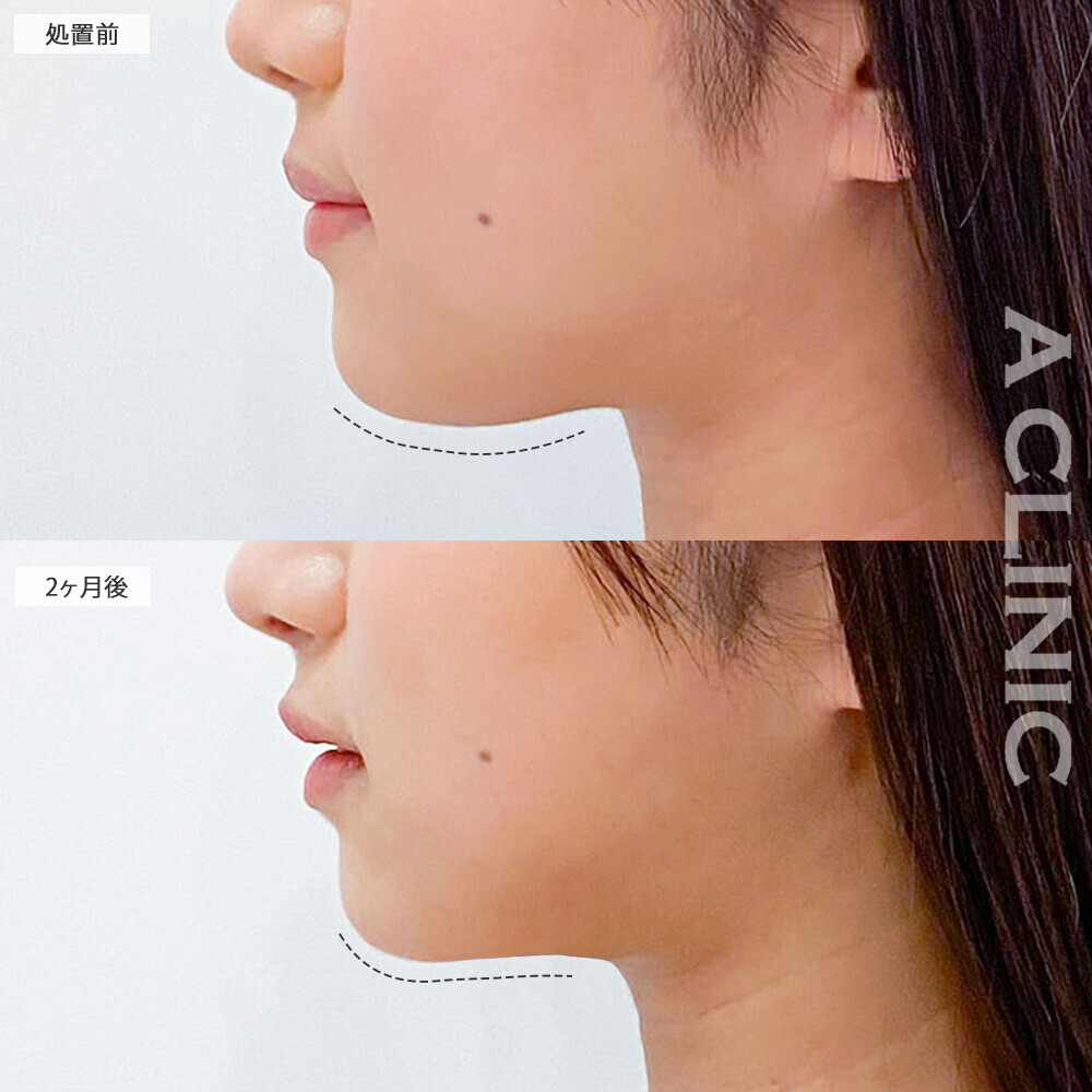 1day小顔脂肪吸引で丸顔から卵形の輪郭に！こちら処置前から２ヶ月後の症例です。(20代女性)