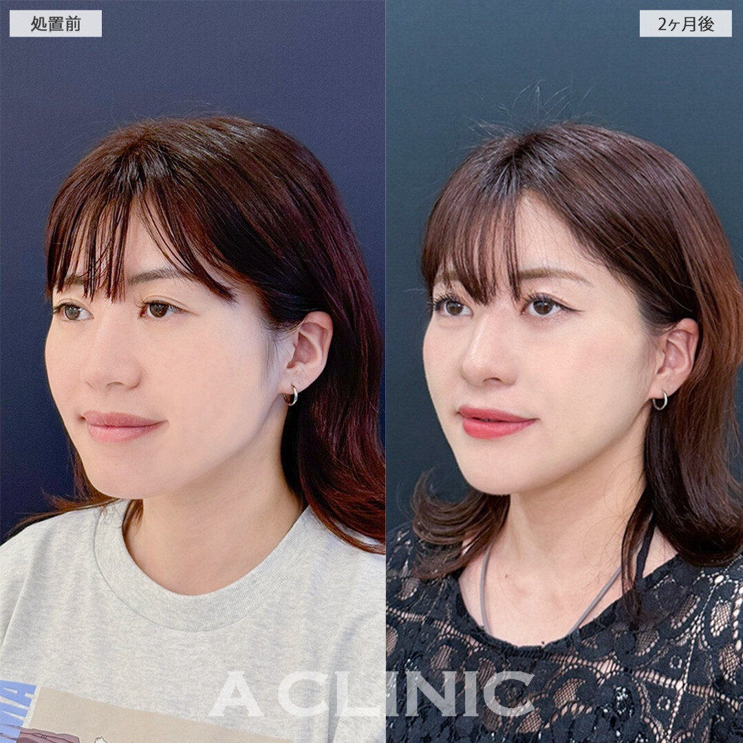 1day小顔脂肪吸引とA式美肌たるみ切開を組み合わせて重心UP！こちら処置前と2ヶ月後の症例です(20代女性)
