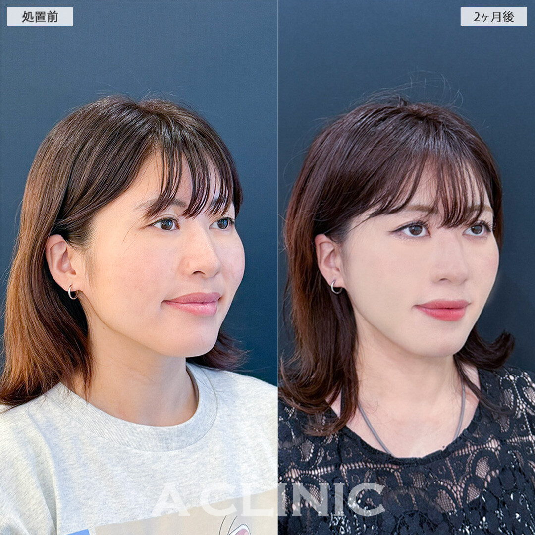 1day小顔脂肪吸引とA式美肌たるみ切開を組み合わせて重心UP！こちら処置前と2ヶ月後の症例です(20代女性)