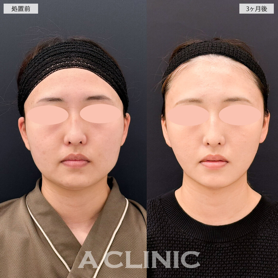 1day小顔脂肪吸引と小顔エラボトックスでスッキリ小顔になりました！こちら処置前と3ヶ月後の症例です(20代女性)